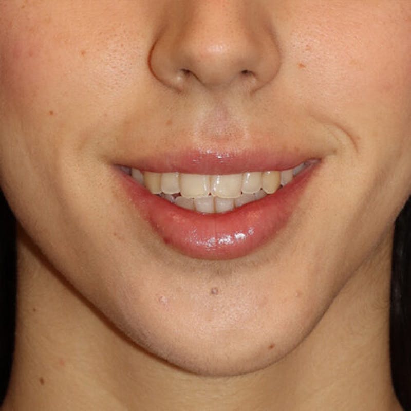 Gummy Smile Correction Before & After Gallery - Patient 142296 - Image 4