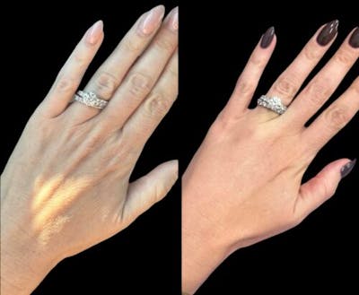 Hand Rejuvenation Before & After Gallery - Patient 417166 - Image 1