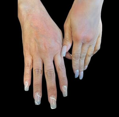 Hand Rejuvenation Before & After Gallery - Patient 417166 - Image 2