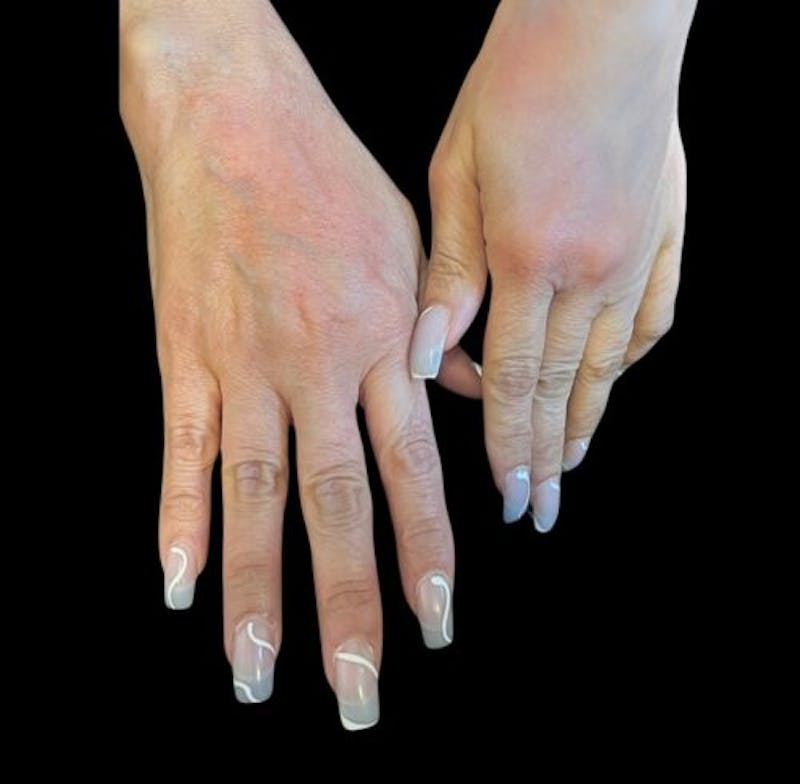Hand Rejuvenation Before & After Gallery - Patient 417166 - Image 2