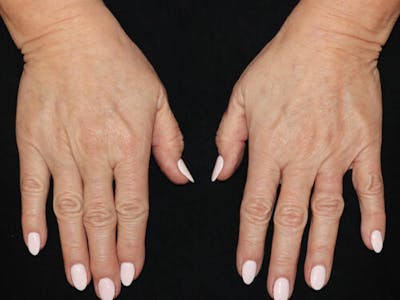 Hand Rejuvenation Before & After Gallery - Patient 501319 - Image 1