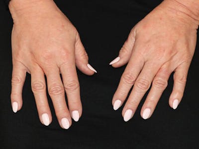 Hand Rejuvenation Before & After Gallery - Patient 501319 - Image 2