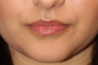 Lip Augmentation Before & After Gallery - Patient 390803 - Image 1