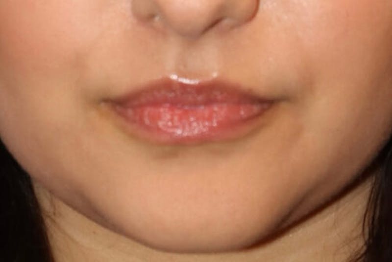 Lip Augmentation Before & After Gallery - Patient 390803 - Image 1