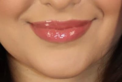 Lip Augmentation Before & After Gallery - Patient 390803 - Image 2