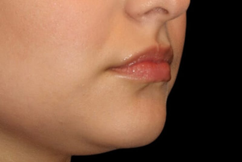 Lip Augmentation Before & After Gallery - Patient 390803 - Image 3