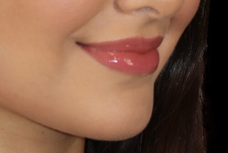 Lip Augmentation Before & After Gallery - Patient 390803 - Image 4