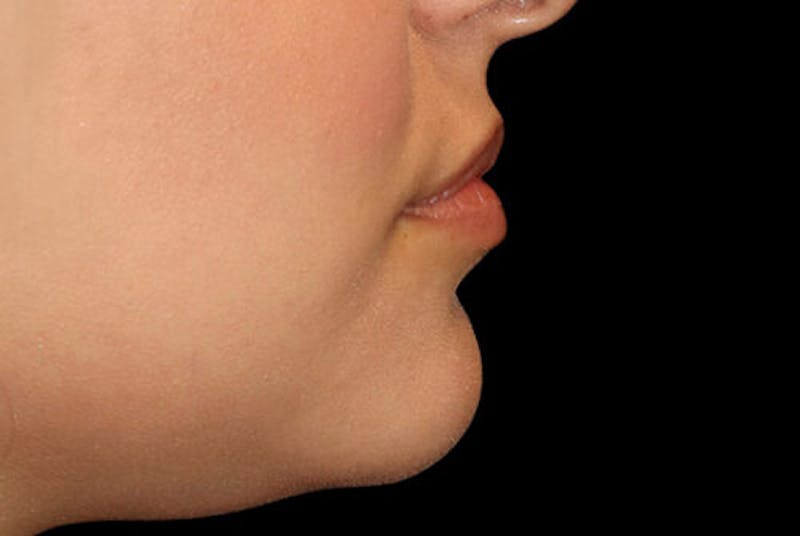 Lip Augmentation Before & After Gallery - Patient 390803 - Image 5