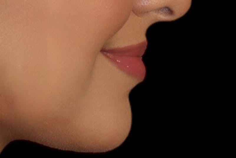 Lip Augmentation Before & After Gallery - Patient 390803 - Image 6