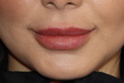 Lip Augmentation Before & After Gallery - Patient 233635 - Image 1