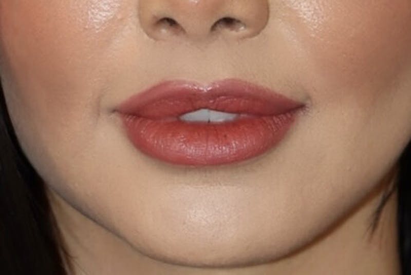 Lip Augmentation Before & After Gallery - Patient 233635 - Image 2