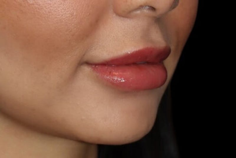 Lip Augmentation Before & After Gallery - Patient 233635 - Image 3