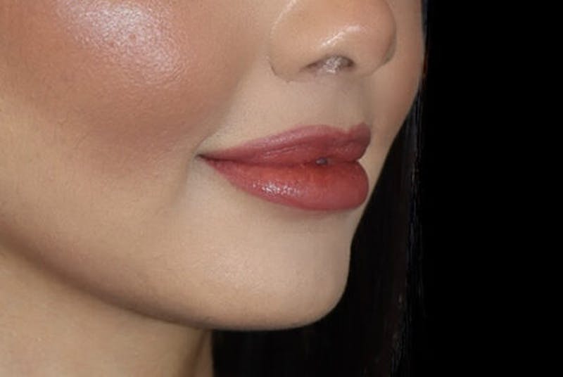 Lip Augmentation Before & After Gallery - Patient 233635 - Image 4