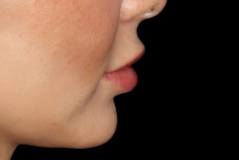 Lip Augmentation Before & After Gallery - Patient 233635 - Image 5