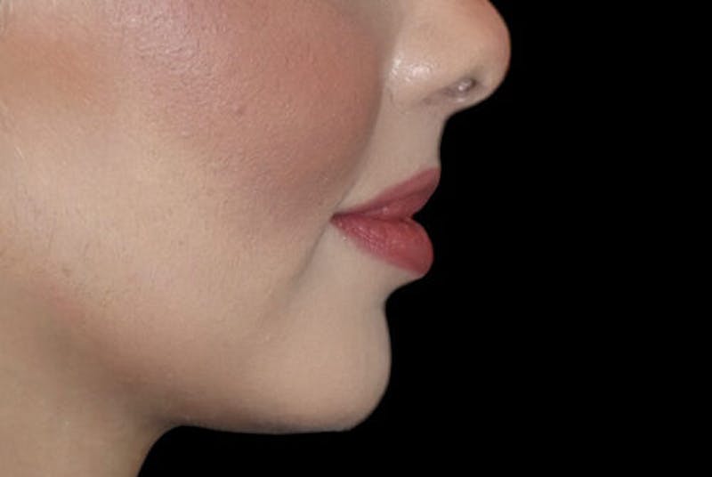 Lip Augmentation Before & After Gallery - Patient 233635 - Image 6