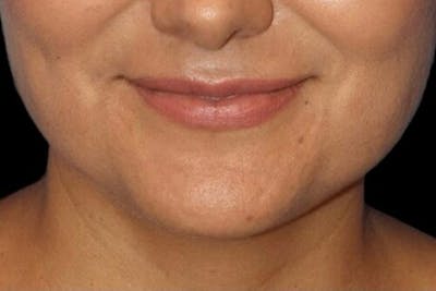 Lip Augmentation Before & After Gallery - Patient 245991 - Image 1