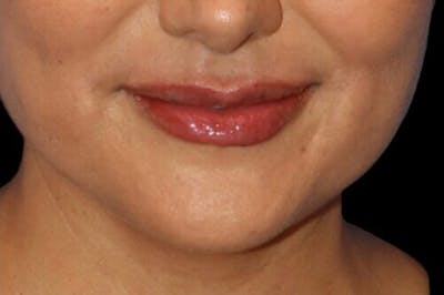 Lip Augmentation Before & After Gallery - Patient 245991 - Image 2