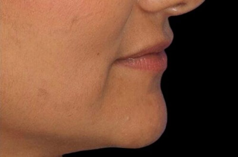 Lip Augmentation Before & After Gallery - Patient 245991 - Image 3
