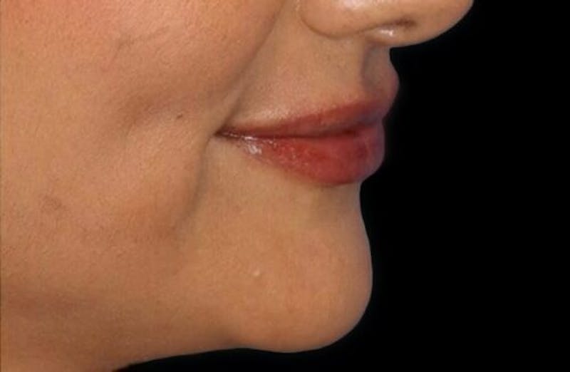 Lip Augmentation Before & After Gallery - Patient 245991 - Image 4
