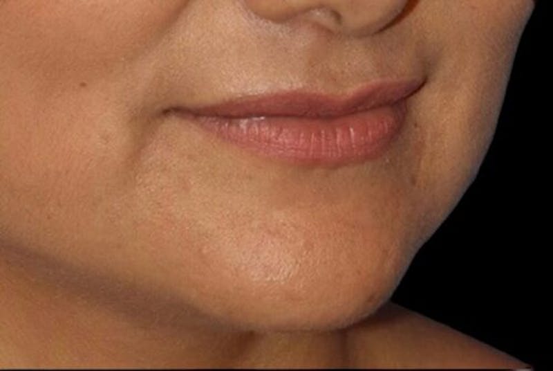 Lip Augmentation Before & After Gallery - Patient 245991 - Image 5