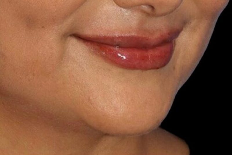 Lip Augmentation Before & After Gallery - Patient 245991 - Image 6