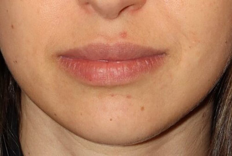 Lip Augmentation Before & After Gallery - Patient 279692 - Image 1