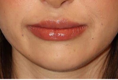 Lip Augmentation Before & After Gallery - Patient 279692 - Image 2