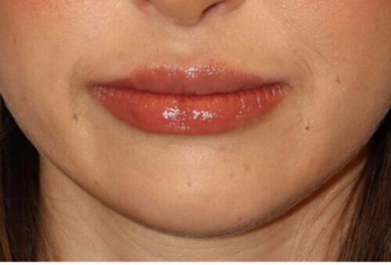 Lip Augmentation Before & After Gallery - Patient 279692 - Image 2