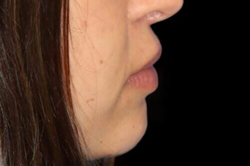 Lip Augmentation Before & After Gallery - Patient 279692 - Image 3