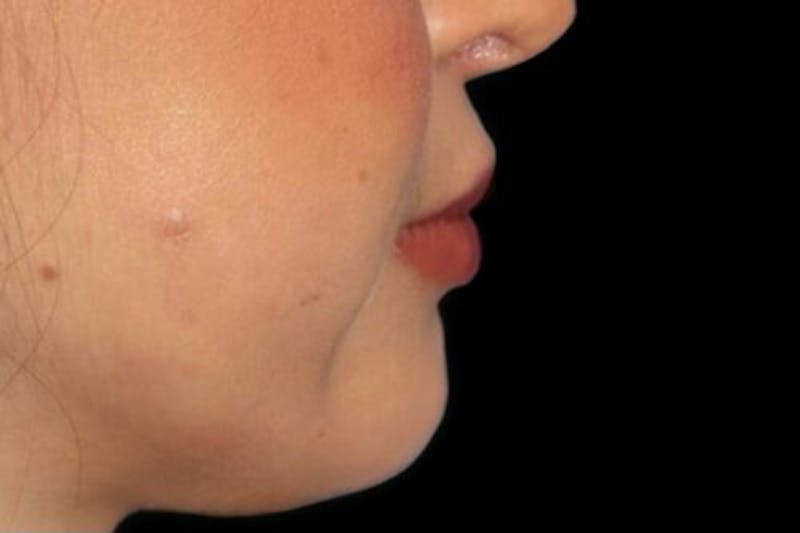 Lip Augmentation Before & After Gallery - Patient 279692 - Image 4
