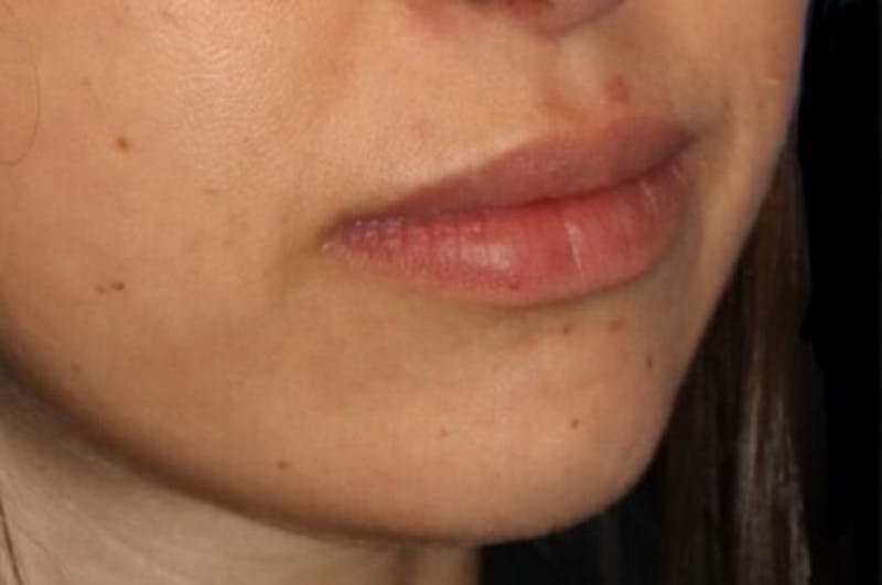 Lip Augmentation Before & After Gallery - Patient 279692 - Image 5