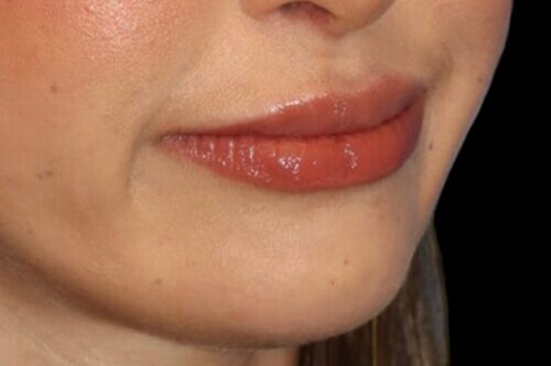 Lip Augmentation Before & After Gallery - Patient 279692 - Image 6