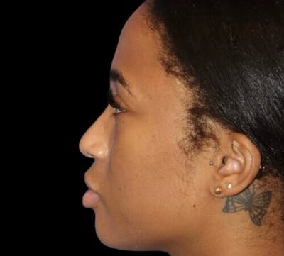 Non-Surgical Rhinoplasty Before & After Gallery - Patient 267351 - Image 1