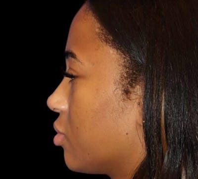Non-Surgical Rhinoplasty Before & After Gallery - Patient 267351 - Image 2