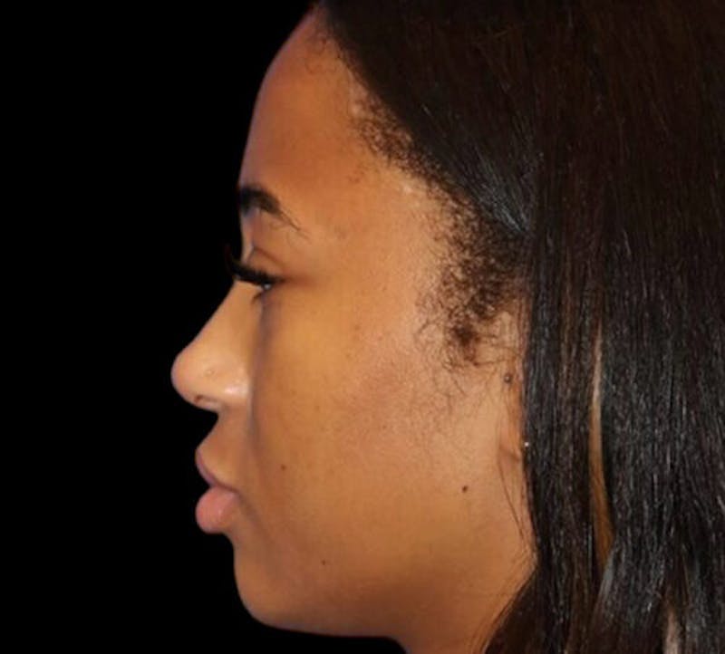 Non-Surgical Rhinoplasty Before & After Gallery - Patient 267351 - Image 2