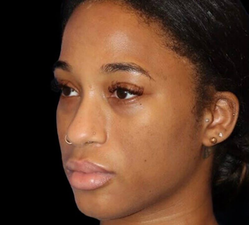 Non-Surgical Rhinoplasty Before & After Gallery - Patient 267351 - Image 3