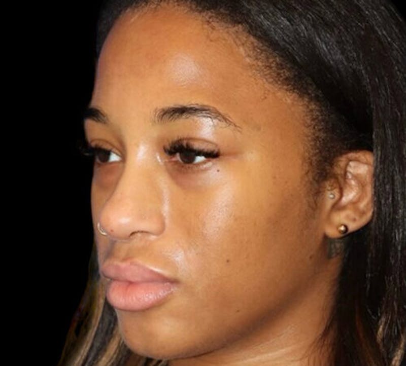 Non-Surgical Rhinoplasty Before & After Gallery - Patient 267351 - Image 4