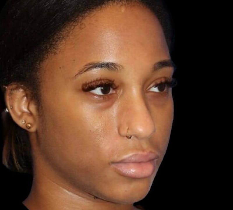 Non-Surgical Rhinoplasty Before & After Gallery - Patient 267351 - Image 5