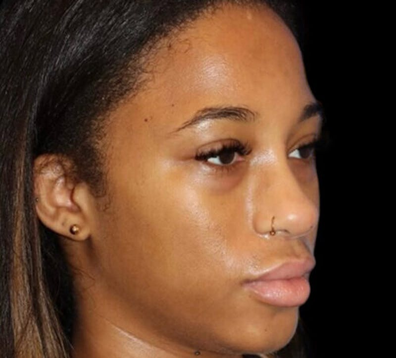 Non-Surgical Rhinoplasty Before & After Gallery - Patient 267351 - Image 6