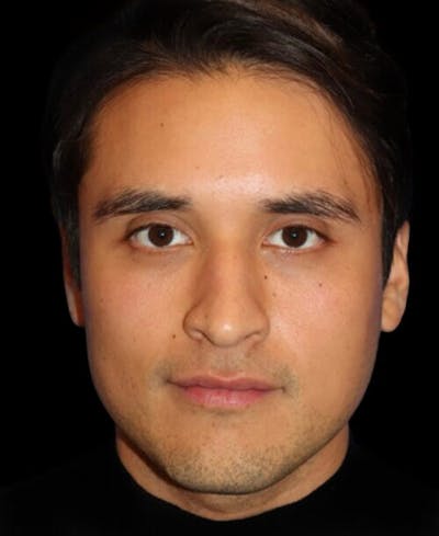 Profile Balancing Before & After Gallery - Patient 367250 - Image 1