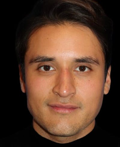 Profile Balancing Before & After Gallery - Patient 367250 - Image 2