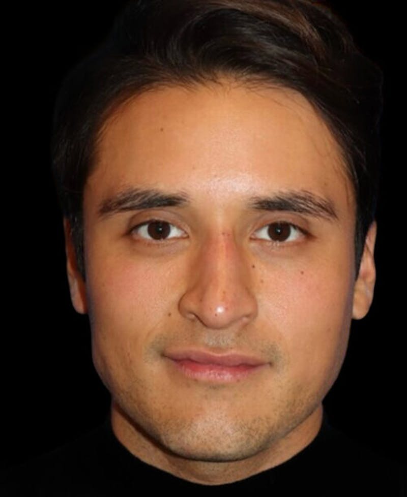 Profile Balancing Before & After Gallery - Patient 367250 - Image 2