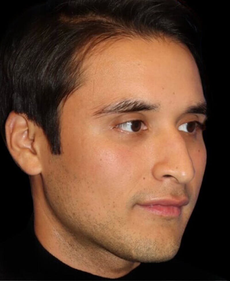 Profile Balancing Before & After Gallery - Patient 367250 - Image 3