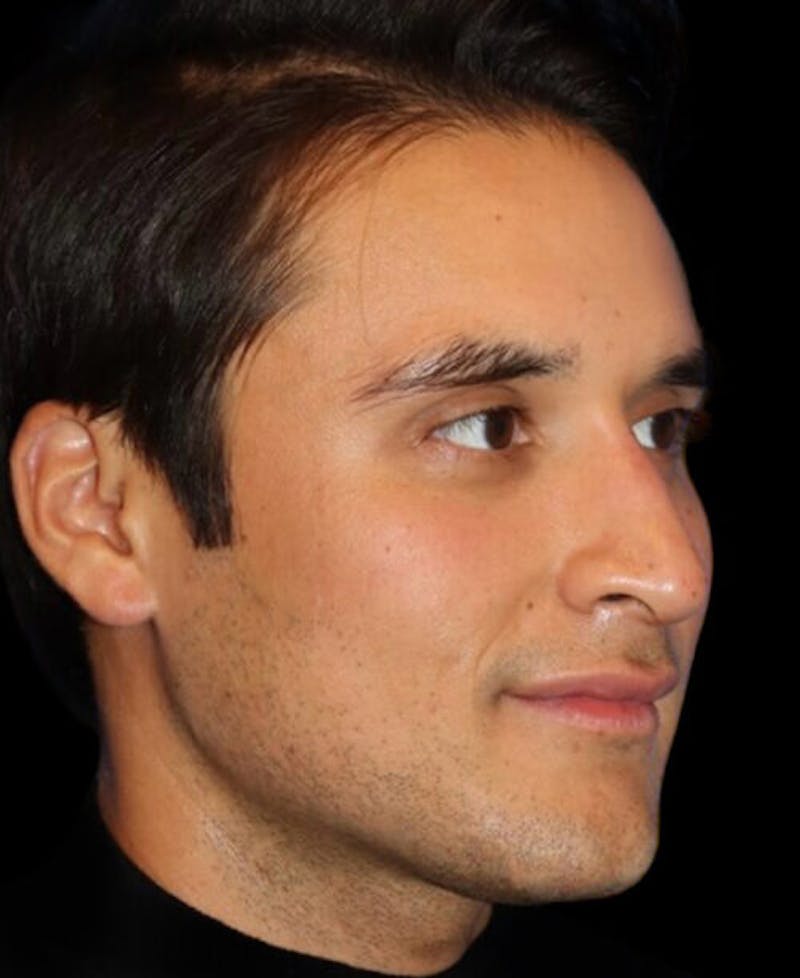 Profile Balancing Before & After Gallery - Patient 367250 - Image 4