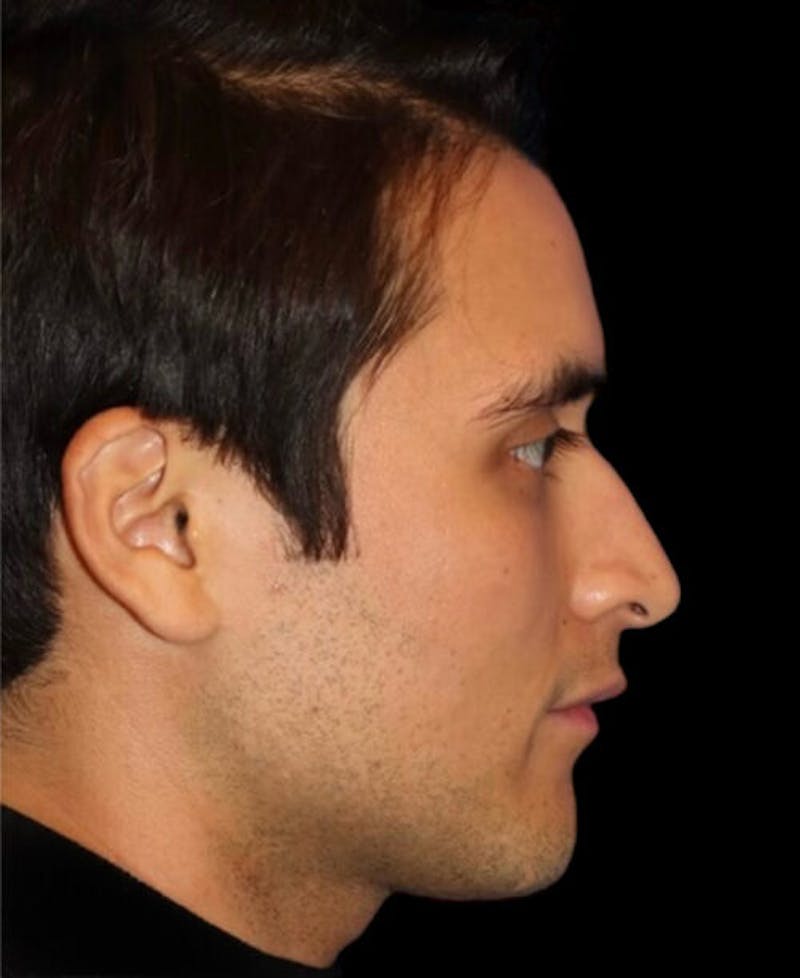 Profile Balancing Before & After Gallery - Patient 367250 - Image 5