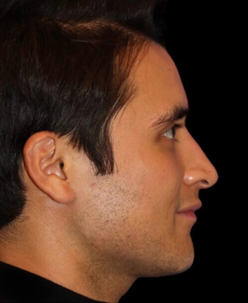 Profile Balancing Before & After Gallery - Patient 367250 - Image 6