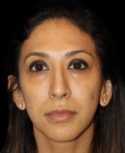 Profile Balancing Before & After Gallery - Patient 387558 - Image 1