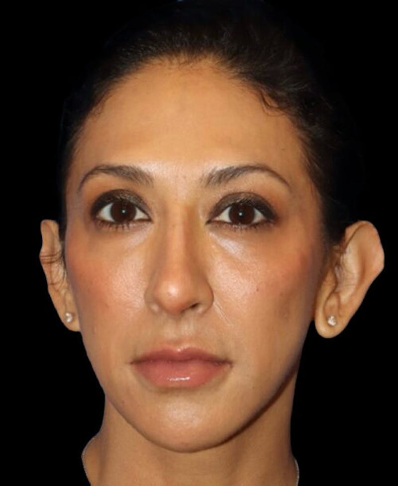 Profile Balancing Before & After Gallery - Patient 387558 - Image 2