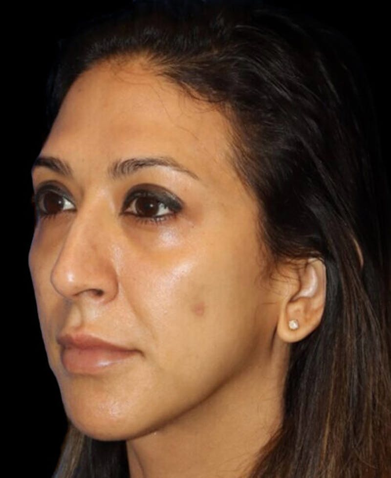 Profile Balancing Before & After Gallery - Patient 387558 - Image 3