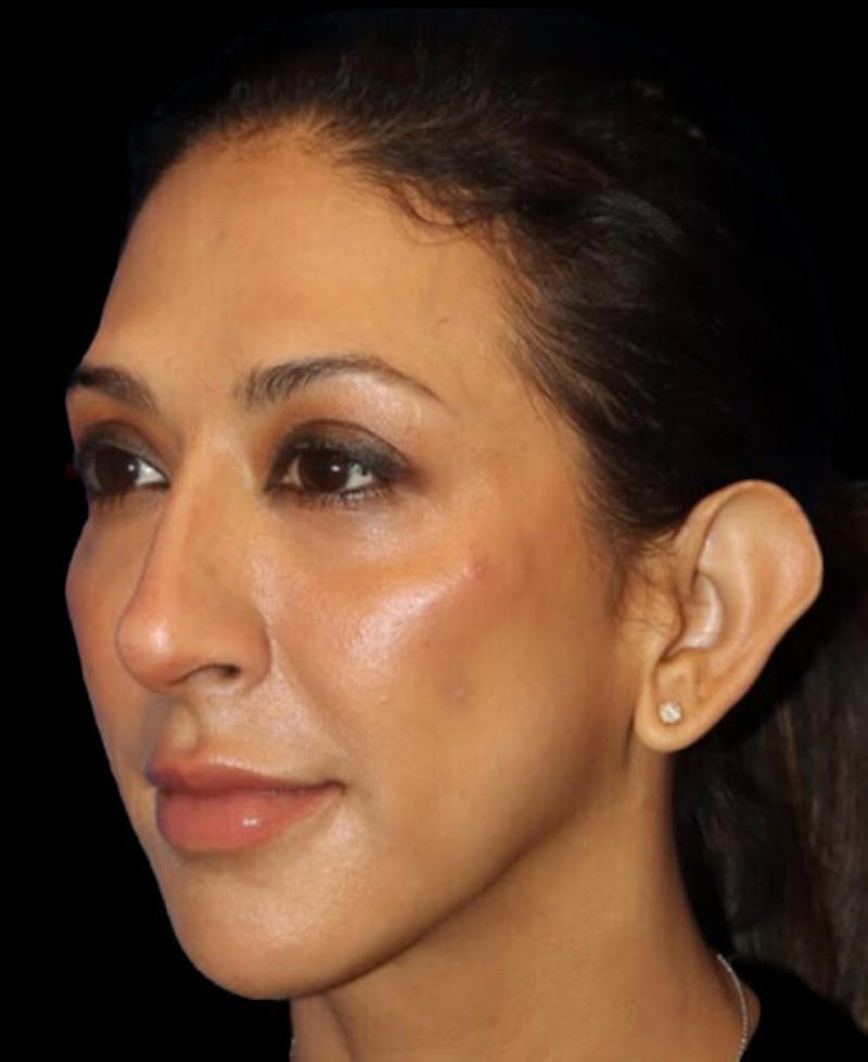 Profile Balancing Before & After Gallery - Patient 387558 - Image 4